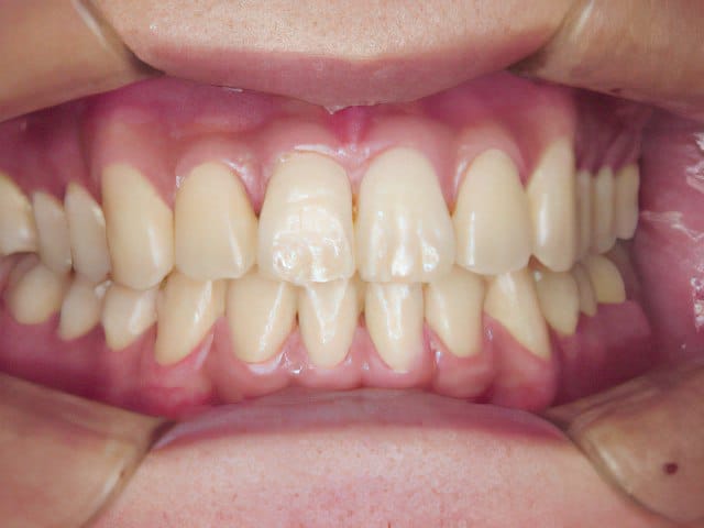矯正歯科治療事例３：治療後