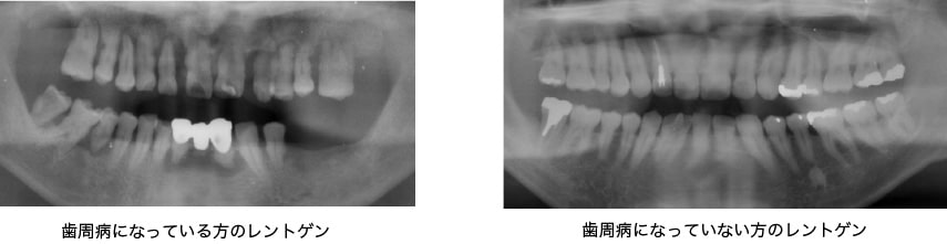 歯周病の歯（左）と健康な歯（右）の違いのレントゲン写真