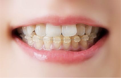 歯の矯正治療