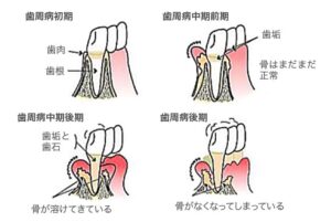 歯周病を解説した図