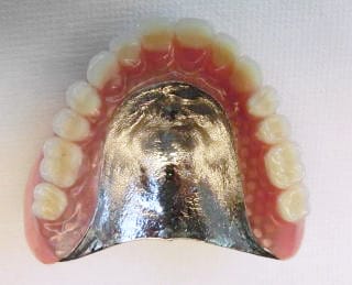 薄く丈夫な入れ歯：金属床義歯