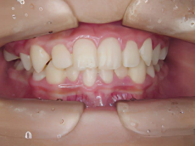 矯正歯科治療事例１：治療後