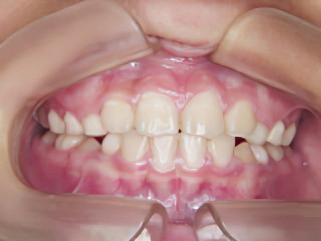 矯正歯科治療事例２：治療後