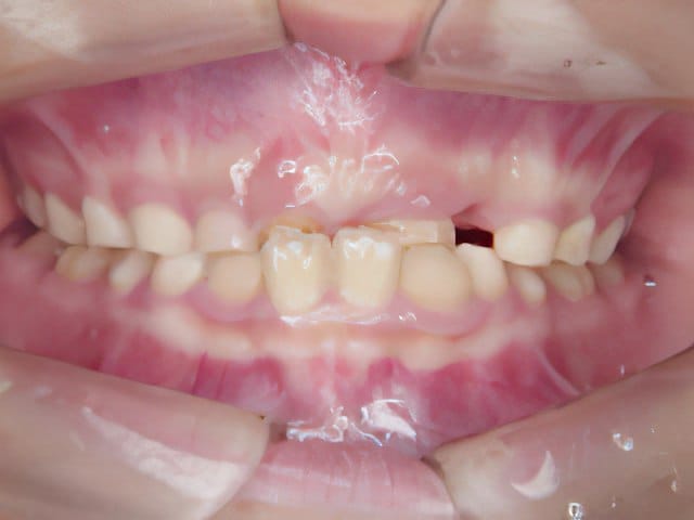 矯正歯科治療事例２：治療前