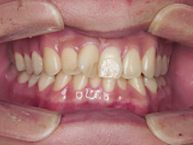 矯正歯科治療事例３：治療前