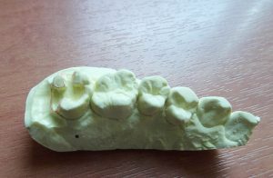 虫歯の部分を削除して、形を整えて型取りをした模型