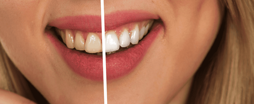 歯の黄ばみを予防する方法